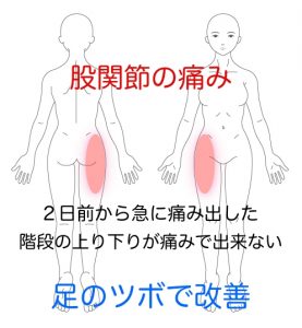股関節痛 鼠径部の痛み 恥骨痛 横須賀市の鍼灸整体院 しん鍼灸院